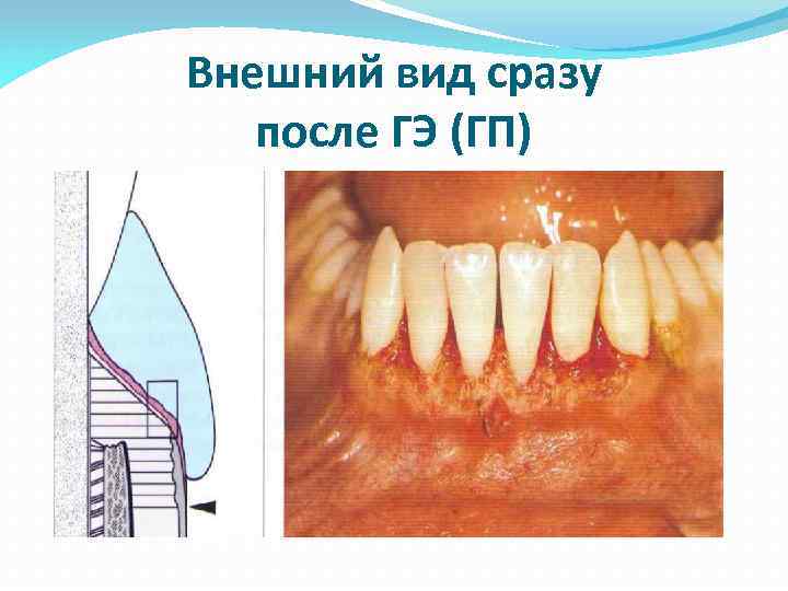 Внешний вид сразу после ГЭ (ГП) 