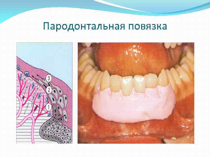 Пародонтальная повязка 