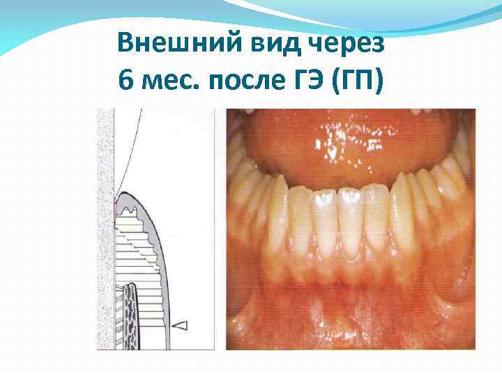 Внешний вид через 6 мес. после ГЭ (ГП) 