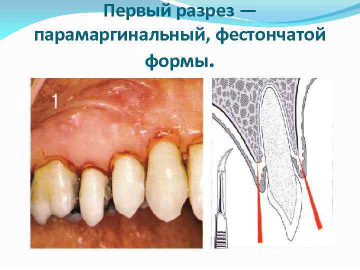 Первый разрез — парамаргинальный, фестончатой формы. 