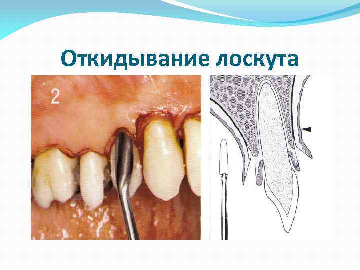 Откидывание лоскута 