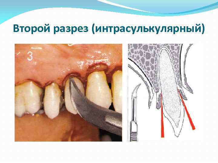 Второй разрез (интрасулькулярный) 