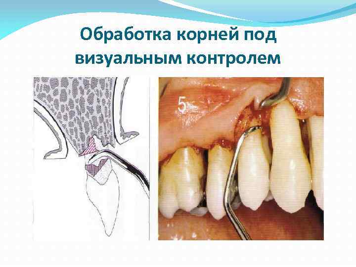 Обработка корней под визуальным контролем 