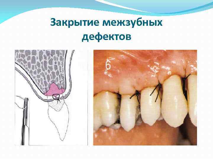 Закрытие межзубных дефектов 