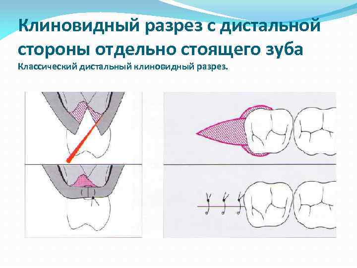 Клиновидный дефект стоматологическая карта