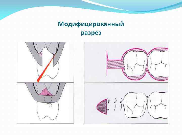 Модифицированный разрез 