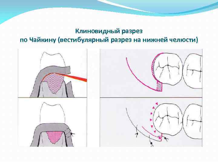 Клиновидный разрез по Чайкину (вестибулярный разрез на нижней челюсти) 