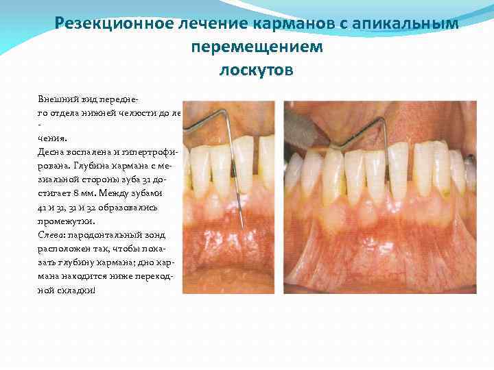 Резекционное лечение карманов с апикальным перемещением лоскутов Внешний вид переднего отдела нижней челюсти до