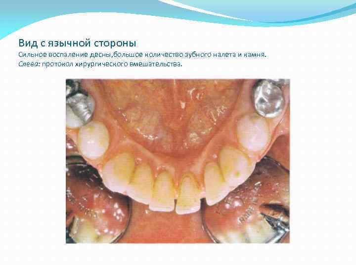 Вид с язычной стороны Сильное воспаление десны, большое количество зубного налета и камня. Слева: