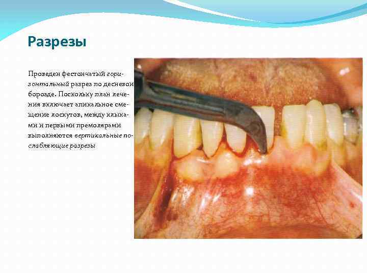 Разрезы Проведен фестончатый горизонтальный разрез по десневои борозде. Поскольку план лечения включает апикальное смещение