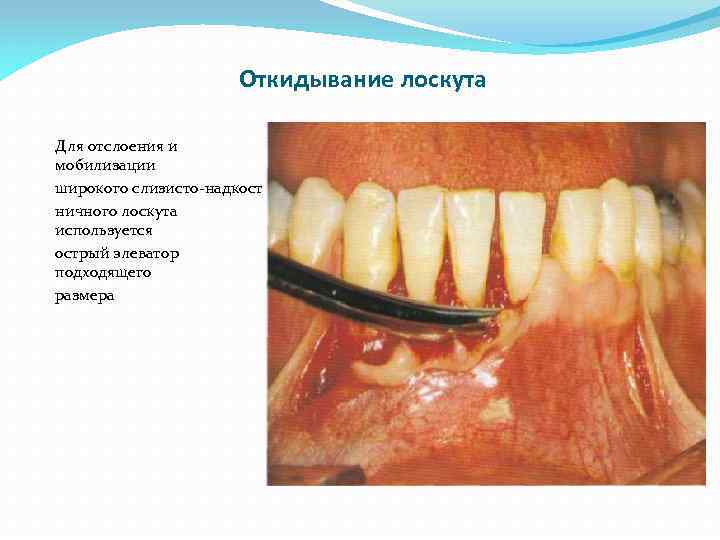 Откидывание лоскута Для отслоения и мобилизации широкого слизисто-надкостничного лоскута используется острый элеватор подходящего размера