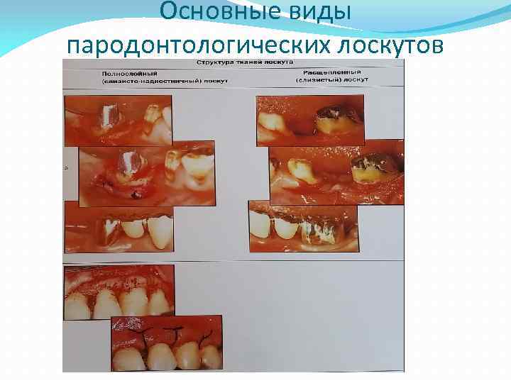 Основные виды пародонтологических лоскутов 