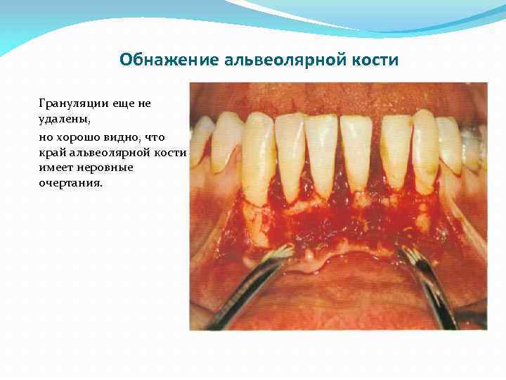 Обнажение альвеолярной кости Грануляции еще не удалены, но хорошо видно, что край альвеолярной кости