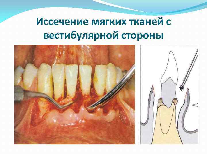 Иссечение мягких тканей с вестибулярной стороны 