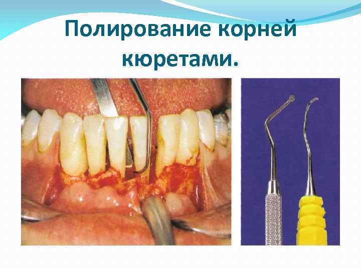 Полирование корней кюретами. 