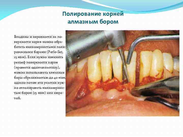 Полирование корней алмазным бором Впадины и неровности на поверхности корня можно обработать мелкозернистыми полировочными