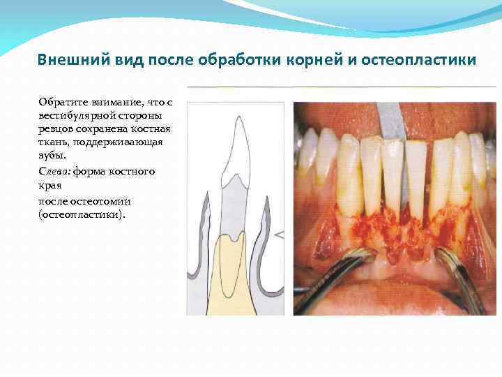 Внешний вид после обработки корней и остеопластики Обратите внимание, что с вестибулярной стороны резцов