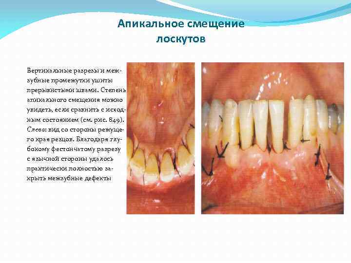 Апикальное смещение лоскутов Вертикальные разрезы и межзубные промежутки ушиты прерывистыми швами. Степень апикального смещения