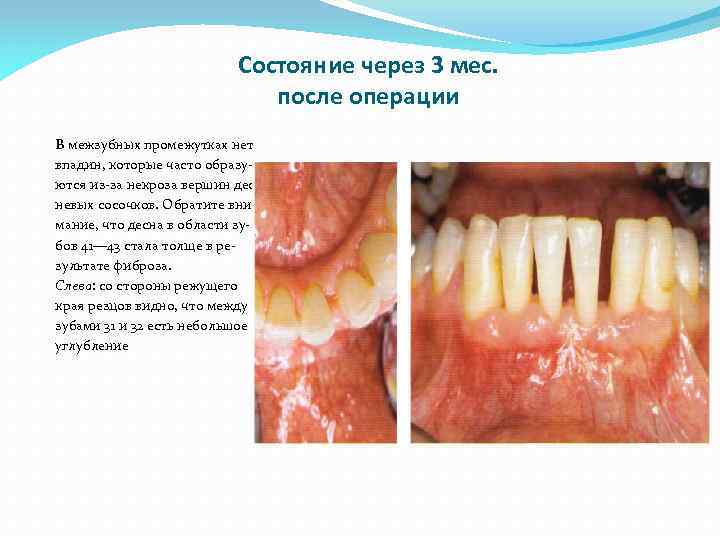Состояние через 3 мес. после операции В межзубных промежутках нет впадин, которые часто образуются
