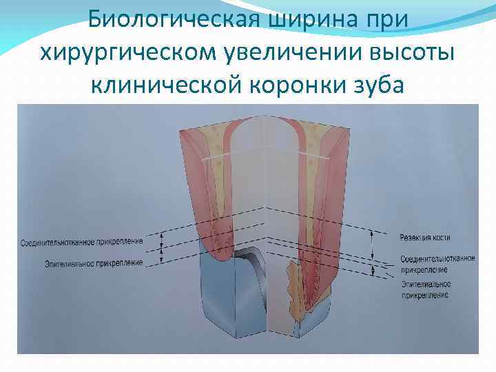 Биологическая ширина при хирургическом увеличении высоты клинической коронки зуба 