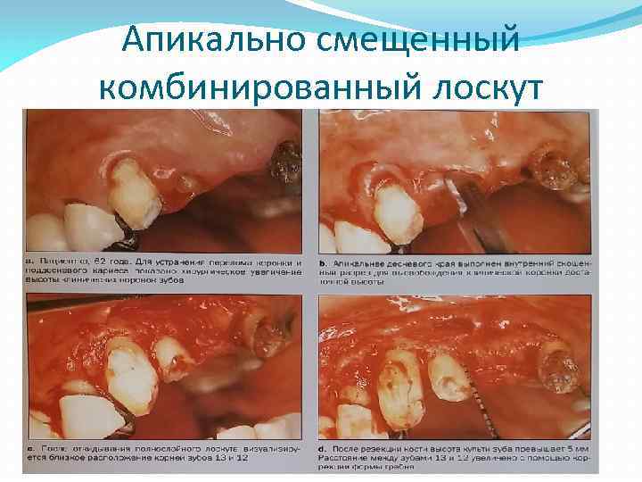 Апикально смещенный комбинированный лоскут 