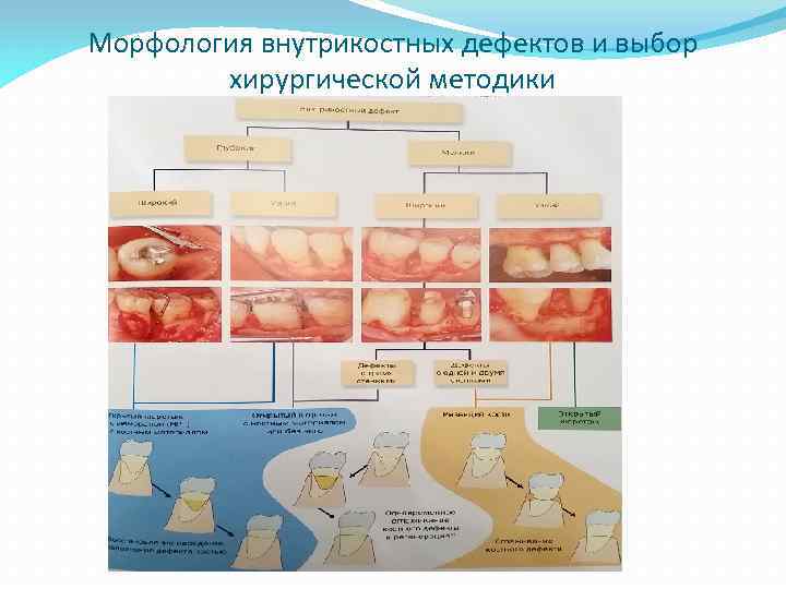 Морфология внутрикостных дефектов и выбор хирургической методики 