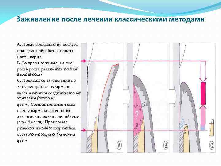 Заживление после лечения классическими методами A. После откидывания лоскута проведена обработка поверхности корня. B.