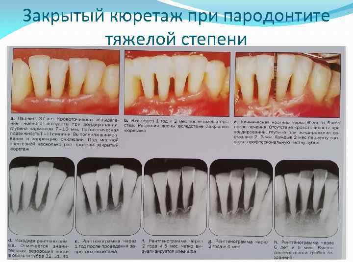 Закрытый кюретаж при пародонтите тяжелой степени 