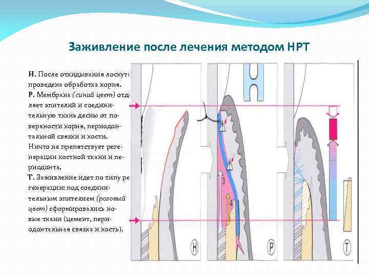 Заживление после лечения методом НРТ Н. После откидывания лоскута проведена обработка корня. Р. Мембрана