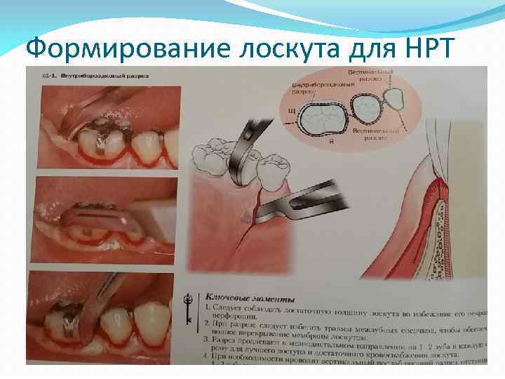 Формирование лоскута для НРТ 