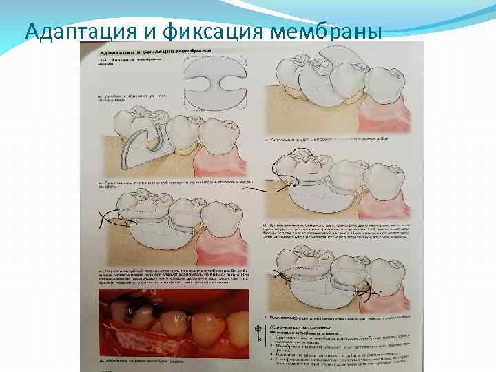 Адаптация и фиксация мембраны 