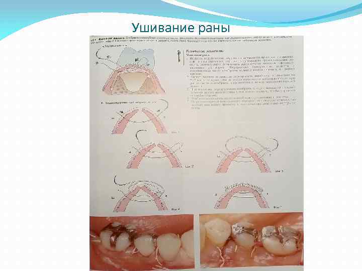 Ушивание раны 