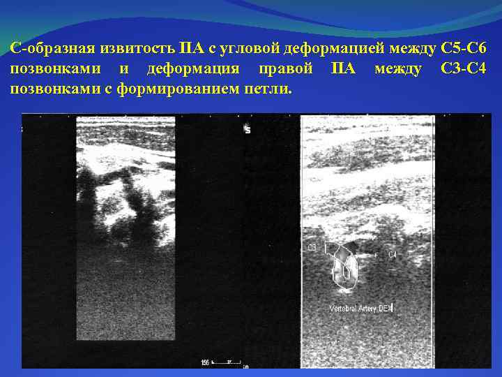 С-образная извитость ПА с угловой деформацией между С 5 -С 6 позвонками и деформация