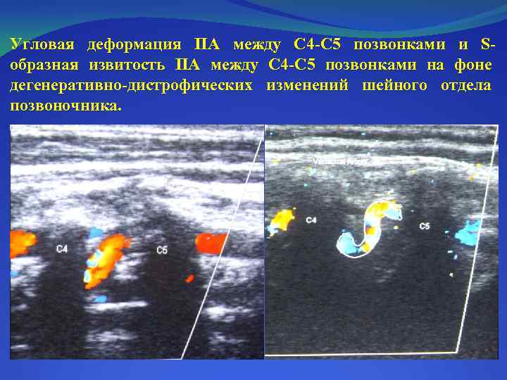 Угловая деформация ПА между С 4 -С 5 позвонками и Sобразная извитость ПА между