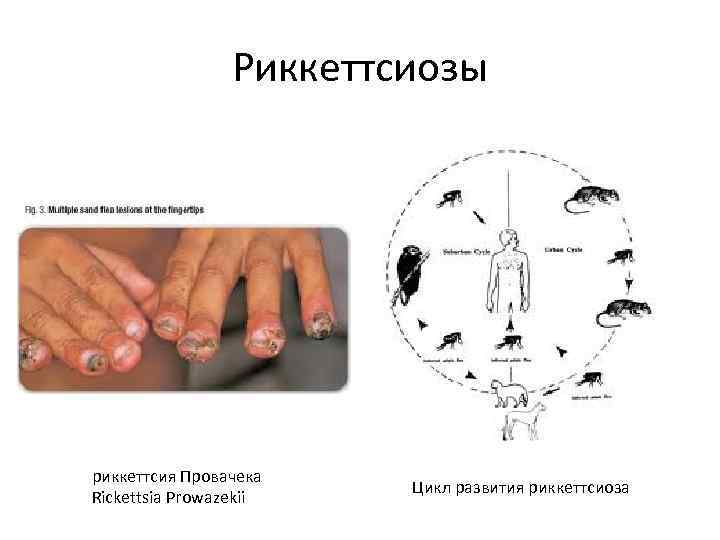 Риккеттсиозы риккеттсия Провачека Rickettsia Prowazekii Цикл развития риккеттсиоза 
