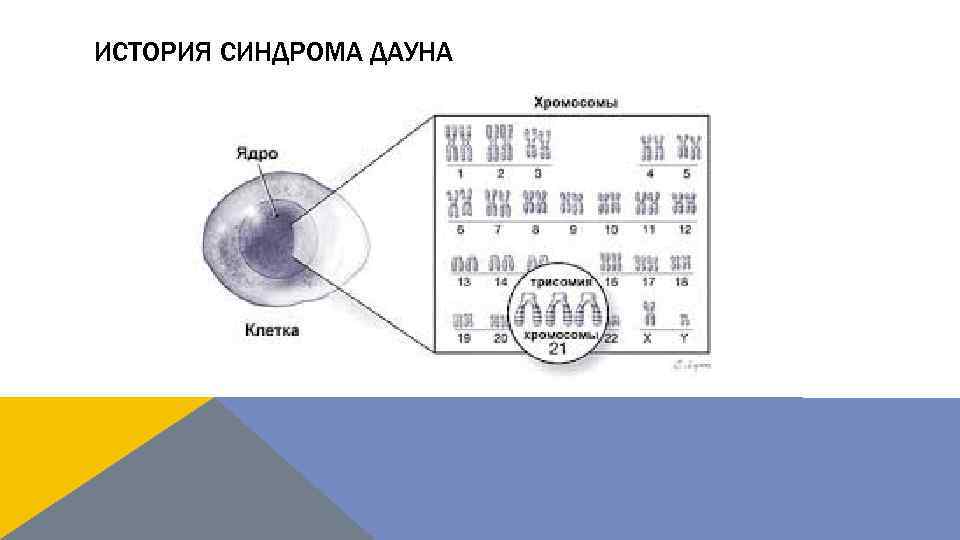 ИСТОРИЯ СИНДРОМА ДАУНА 