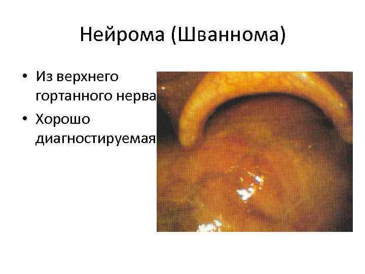 Нейрома (Шваннома) • Из верхнего гортанного нерва • Хорошо диагностируемая 