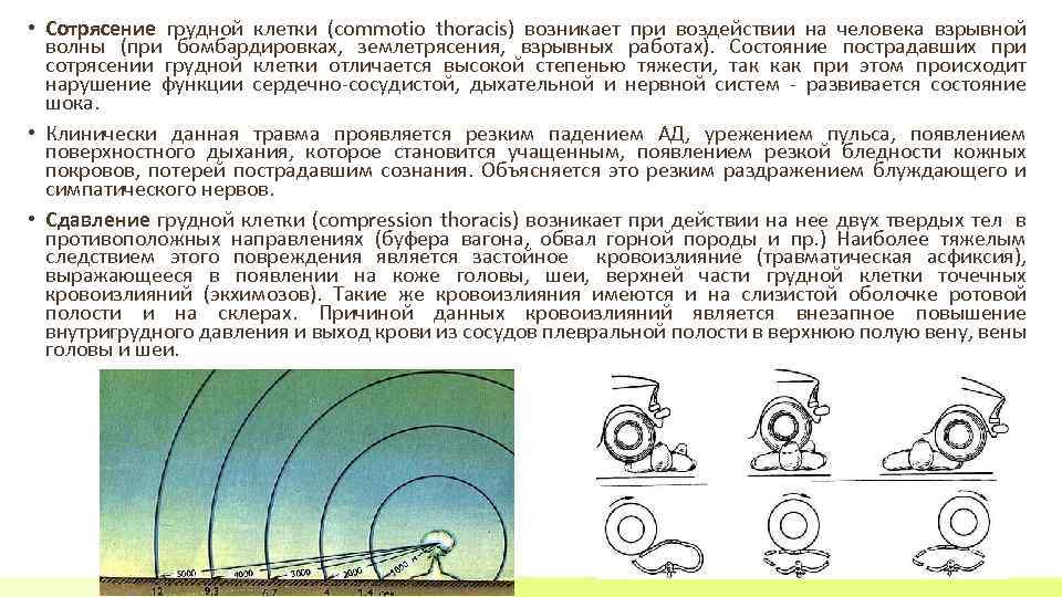  • Сотрясение грудной клетки (commotio thoracis) возникает при воздействии на человека взрывной волны