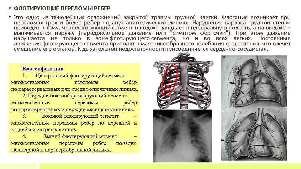  • ФЛОТИРУЮЩИЕ ПЕРЕЛОМЫ РЕБЕР • Это одно из тяжелейших осложнений закрытой травмы грудной