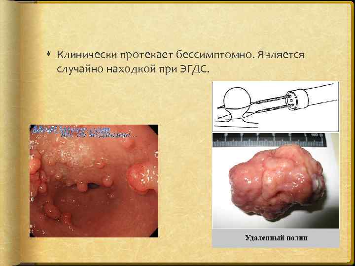  Клинически протекает бессимптомно. Является случайно находкой при ЭГДС. 