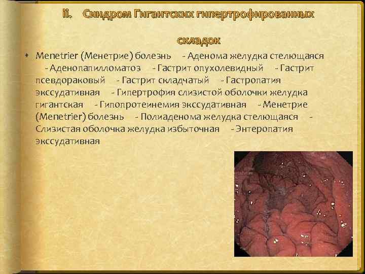 ii. Синдром Гигантских гипертрофированных складок Menetrier (Менетрие) болезнь   - Аденома желудка стелющаяся  