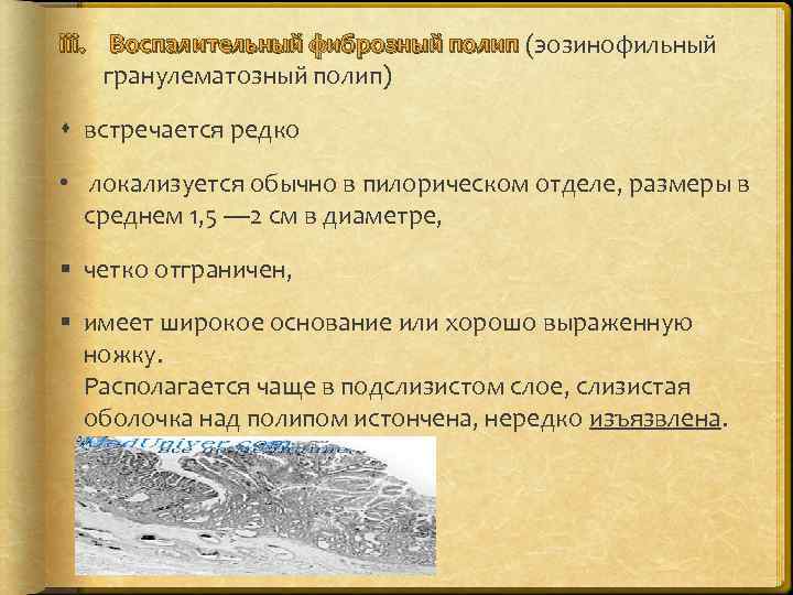 iii. Воспалительный фиброзный полип (эозинофильный гранулематозный полип) встречается редко • локализуется обычно в пилорическом