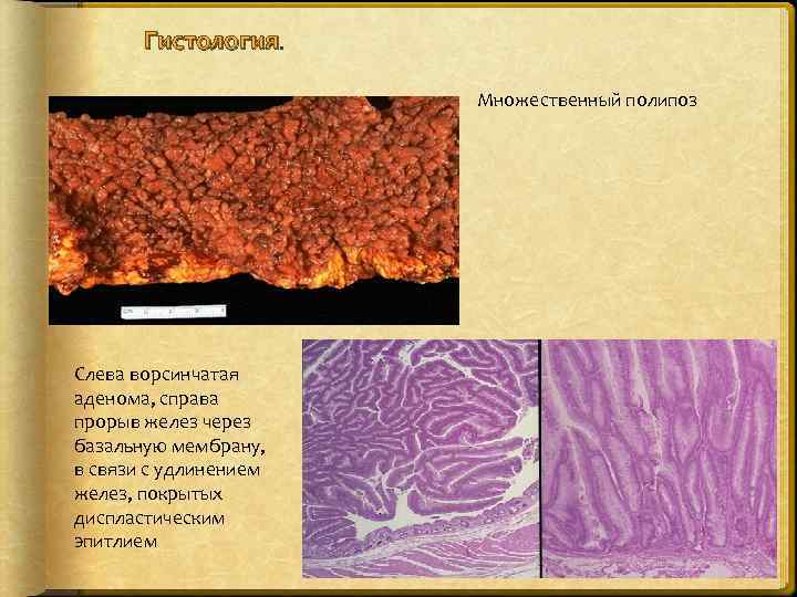 Гистология. Множественный полипоз Слева ворсинчатая аденома, справа прорыв желез через базальную мембрану, в связи