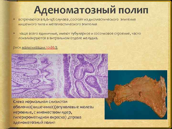 Аденоматозный полип встречаются в 6, 6 -14% случаев , состоят из диспластического эпителия кишечного