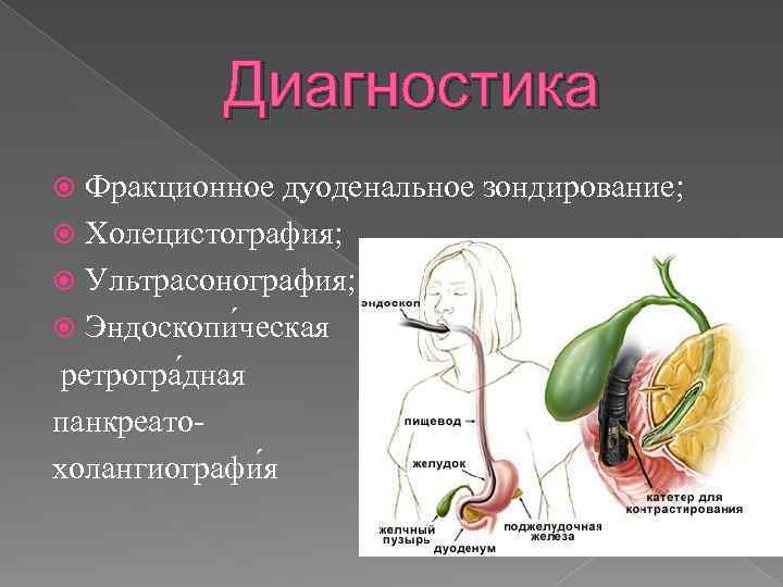 Диагностика Фракционное дуоденальное зондирование; Холецистография; Ультрасонография; Эндоскопи ческая ретрогра дная панкреатохолангиографи я 