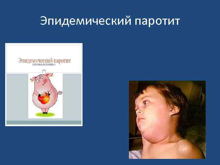 Эпидемический паротит 