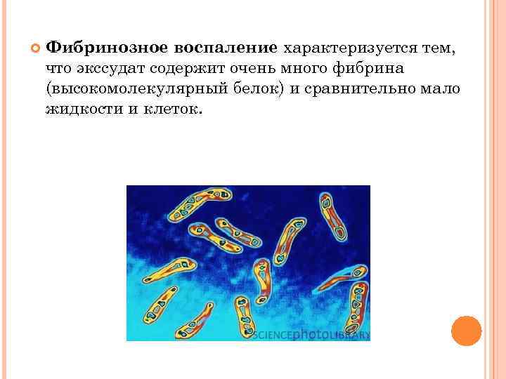  Фибринозное воспаление характеризуется тем, что экссудат содержит очень много фибрина (высокомолекулярный белок) и