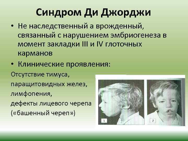 Синдром Ди Джорджи • Не наследственный а врожденный, связанный с нарушением эмбриогенеза в момент