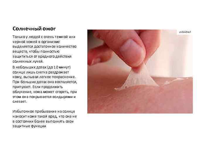 Солнечный ожог Только у людей с очень темной или черной кожей в организме выделяется