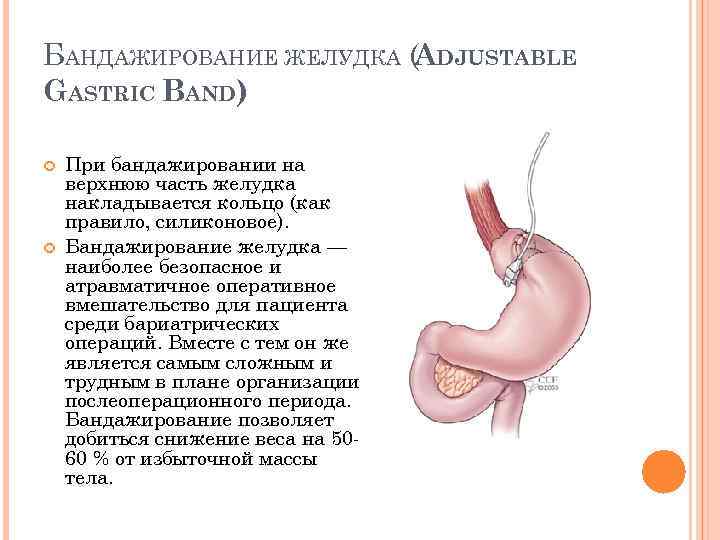 БАНДАЖИРОВАНИЕ ЖЕЛУДКА (ADJUSTABLE GASTRIC BAND) При бандажировании на верхнюю часть желудка накладывается кольцо (как